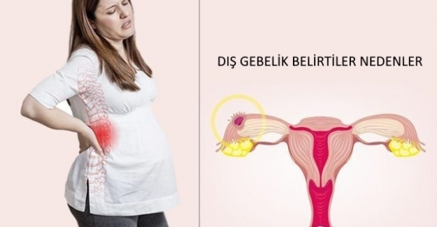 Dış Gebelik nedir? İşaretler Belirtiler Ve Nedenleri