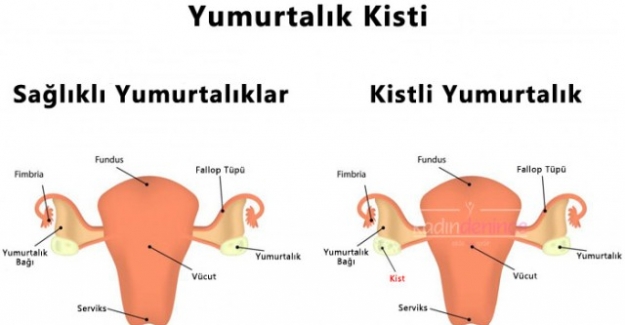 Yumurtalık Kistlerinin Çeşitleri Nelerdir?