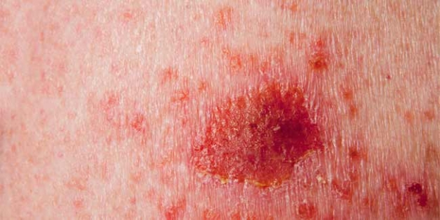 Lyme Hastalığı Nedir? Belirtileri Ve Tedavisi